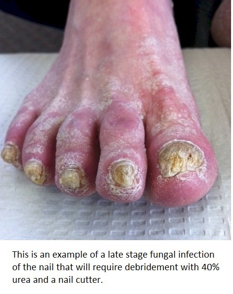 late stage fungal infection of a toe nail